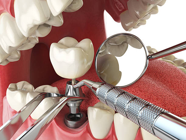 Best Emergency Wisdom Tooth Extraction in Paris, TN